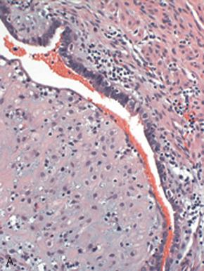 Fig. 21.7, A, Focal ectopic decidual change is common in the tubal mucosa in peripartum tubal ligation specimens. This decidual change was the result of Megestrol therapy. B, Marginated neutrophils associated with operative manipulation.