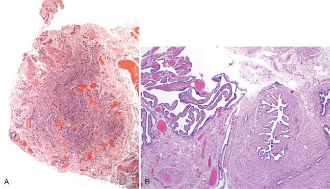 Fig. 21.8, Mimics of normal tube. A, Round ligament. B, Fallopian tube (left) adjacent to a müllerian duct remnant (right). The latter could mimic a tubal section in tubal sterilization procedures.