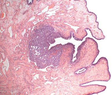 Fig. 21.10, Incidentally discovered microscopic (2 mm) serous malignancy of the fimbria detected in a routine specimen from a woman undergoing surgery for a benign ovarian tumor (fibroma).