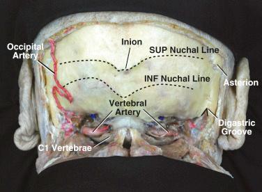 Figure 22.1, Anatomy of the far lateral approach.