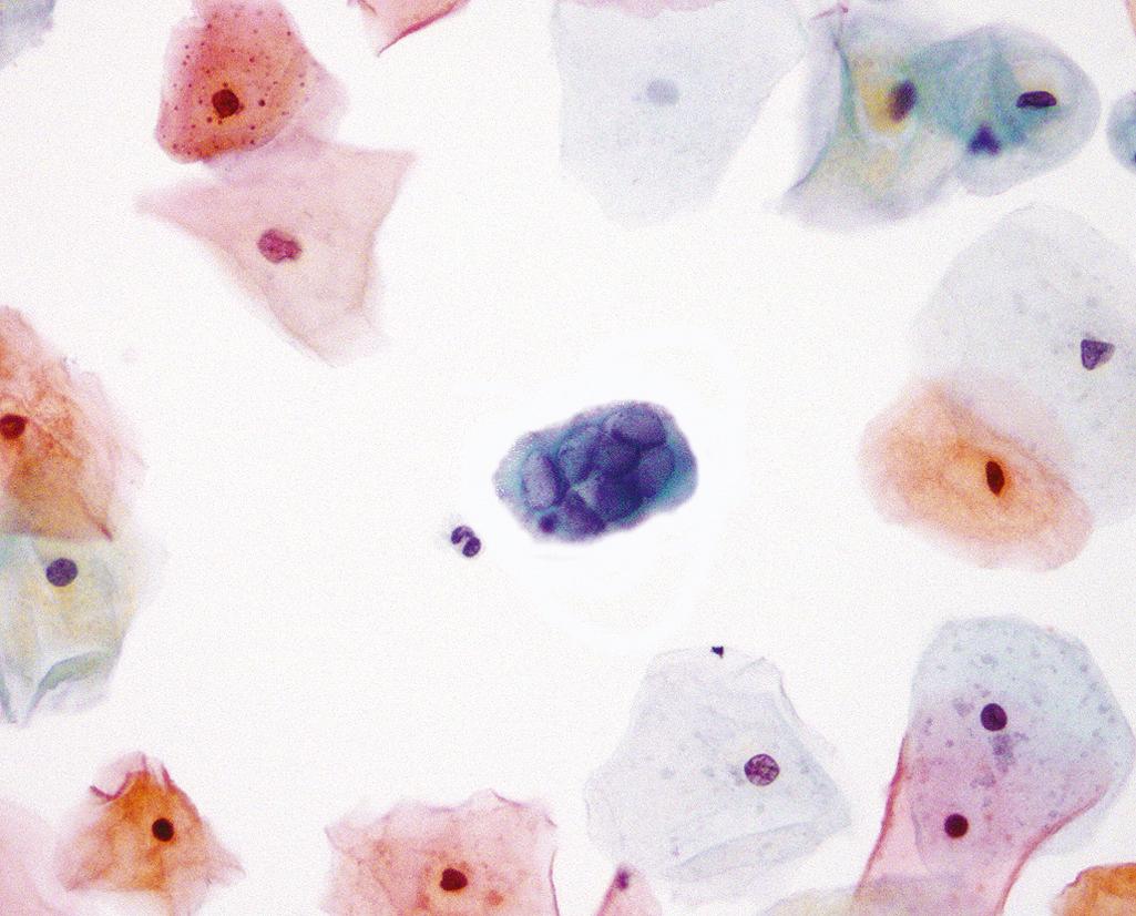 Figure 22.2, Herpes simplex virus (HSV) infection (cervical smear). The cell in the center shows HSV cytopathic effect. Infected cells become multinucleated and contain intranuclear viral inclusions with a characteristic “ground-glass” appearance.