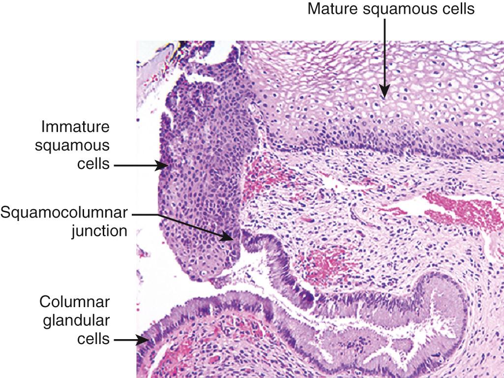 Figure 22.12, Cervical squamocolumnar junction showing a transition from mature, glycogenized squamous epithelium to columnar endocervical glandular epithelium. The superficial, mature squamous epithelial cells are not susceptible to human papillomavirus (HPV) infection. The HPV-susceptible cells include immature basal squamous cells and endocervical glandular cells.