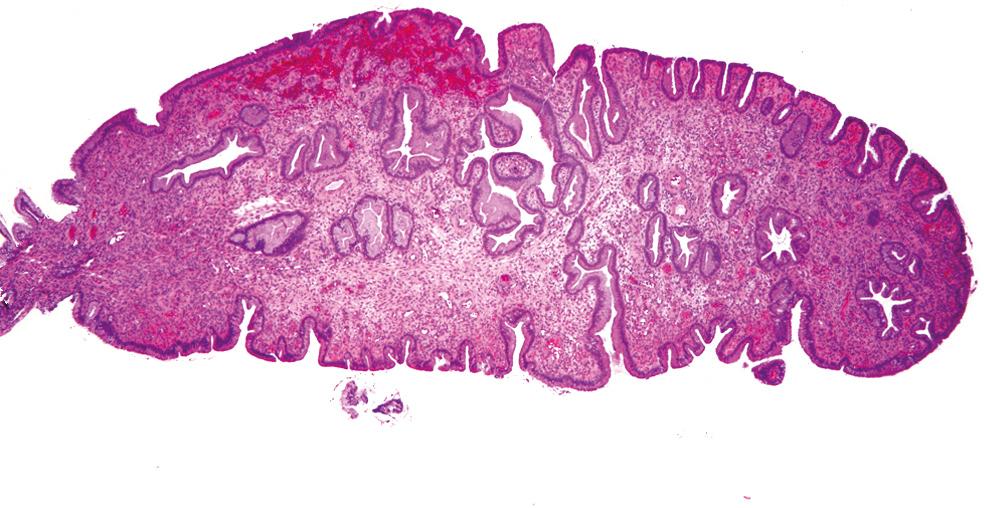 Figure 22.13, Endocervical polyp composed of a dense fibrous stroma covered with endocervical columnar epithelium.