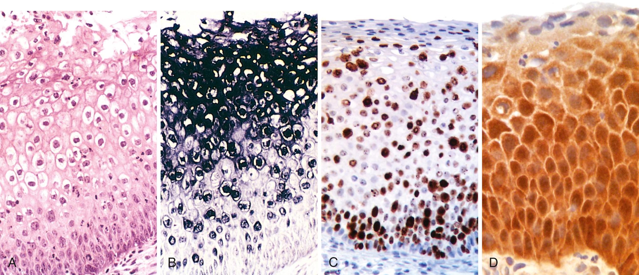 Figure 22.15, (A) Low-grade squamous intraepithelial lesion: routine hematoxylin and eosin staining shows koilocytic change, seen as nuclear enlargement and perinuclear “halos.” (B) In situ hybridization test for human papillomavirus deoxyribonucleic acid (HPV DNA). The dark granular staining denotes HPV DNA, which is most abundant in the superficial koilocytes. (C) Diffuse positivity for the proliferation marker Ki-67 (seen as brown nuclear staining), illustrates expansion of the proliferating cells from the normal basal location to the superficial layers of the epithelium. (D) Up-regulation of the cyclin-dependent kinase inhibitor p16 (seen here as brown staining) characterizes high-risk HPV infections.