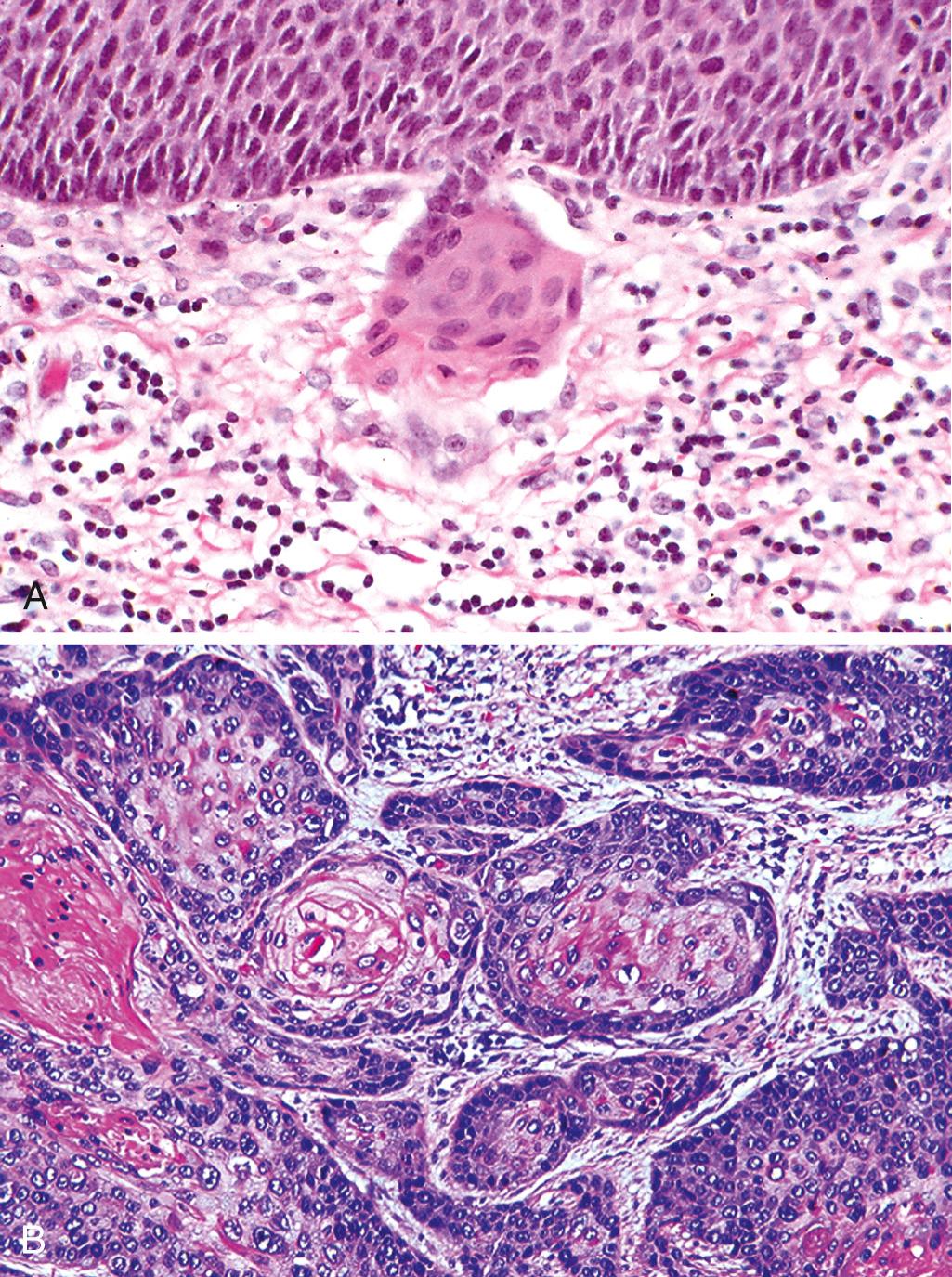 Figure 22.16, Squamous cell carcinoma of the cervix. (A) Early invasion in squamous cell carcinoma showing an invasive nest breaking through the basement membrane of a high-grade squamous intraepithelial lesion. (B) Invasive squamous cell carcinoma.