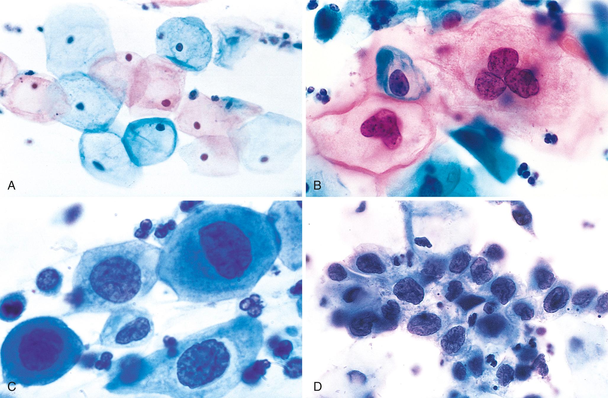 Figure 22.18, The cytology of cervical intraepithelial neoplasia as seen on the Papanicolaou smear. The cytoplasmic staining of desquamated cells may be either red or blue. (A) Normal exfoliated superficial squamous cells. (B) Low-grade squamous intraepithelial lesion—koilocytes. (C) High-grade squamous intraepithelial lesion (HSIL; cervical intraepithelial neoplasia [CIN] II). (D) HSIL (CIN III). Note the reduction in cytoplasm and the increase in the nucleus-to-cytoplasm ratio, which occurs as the grade of the lesion increases. This reflects the progressive loss of cellular differentiation on the surface of the lesions from which these cells are exfoliated.