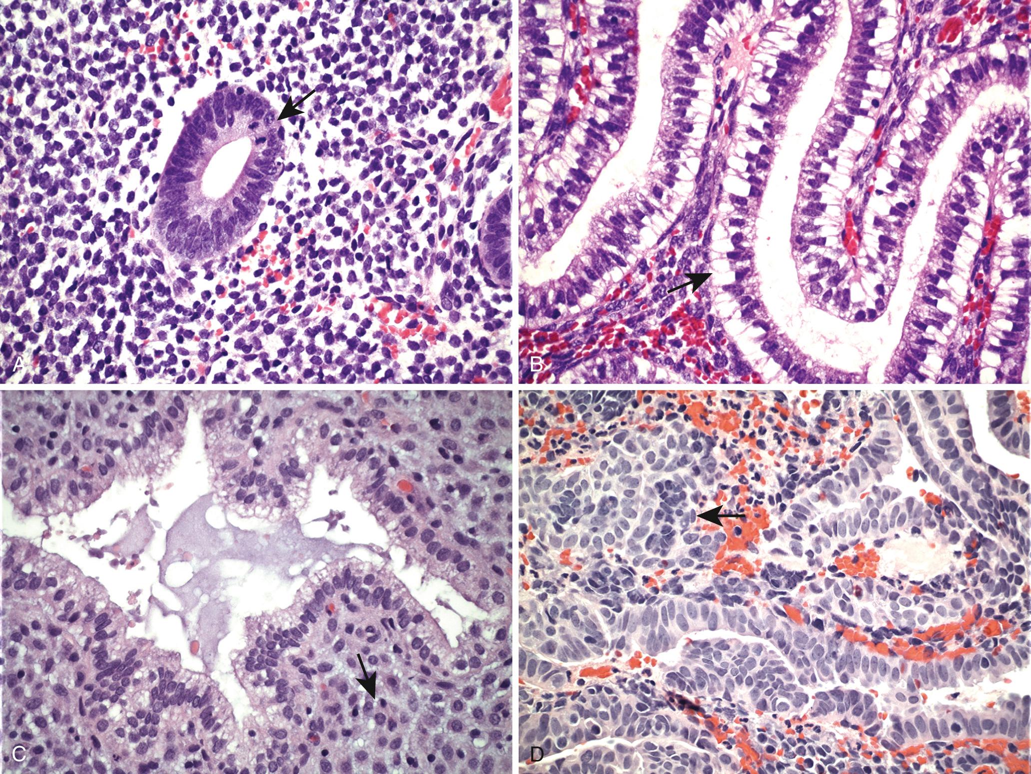 Figure 22.19, Histology of the menstrual cycle. (A) Proliferative phase with mitoses (arrow) . (B) Early secretory phase with subnuclear vacuoles (arrow) . (C) Late secretory exhaustion and predecidual changes (arrow) . (D) Menstrual endometrium with stromal breakdown (arrow) (see text).