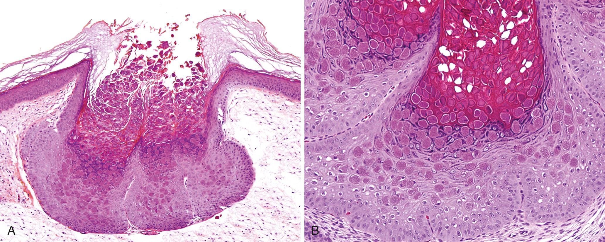 Figure 22.3, Molluscum contagiosum infection. (A) Low-power appearance of a dome-shaped papule with dimpled center. (B) High-power magnification reveals intracytoplasmic viral inclusions.