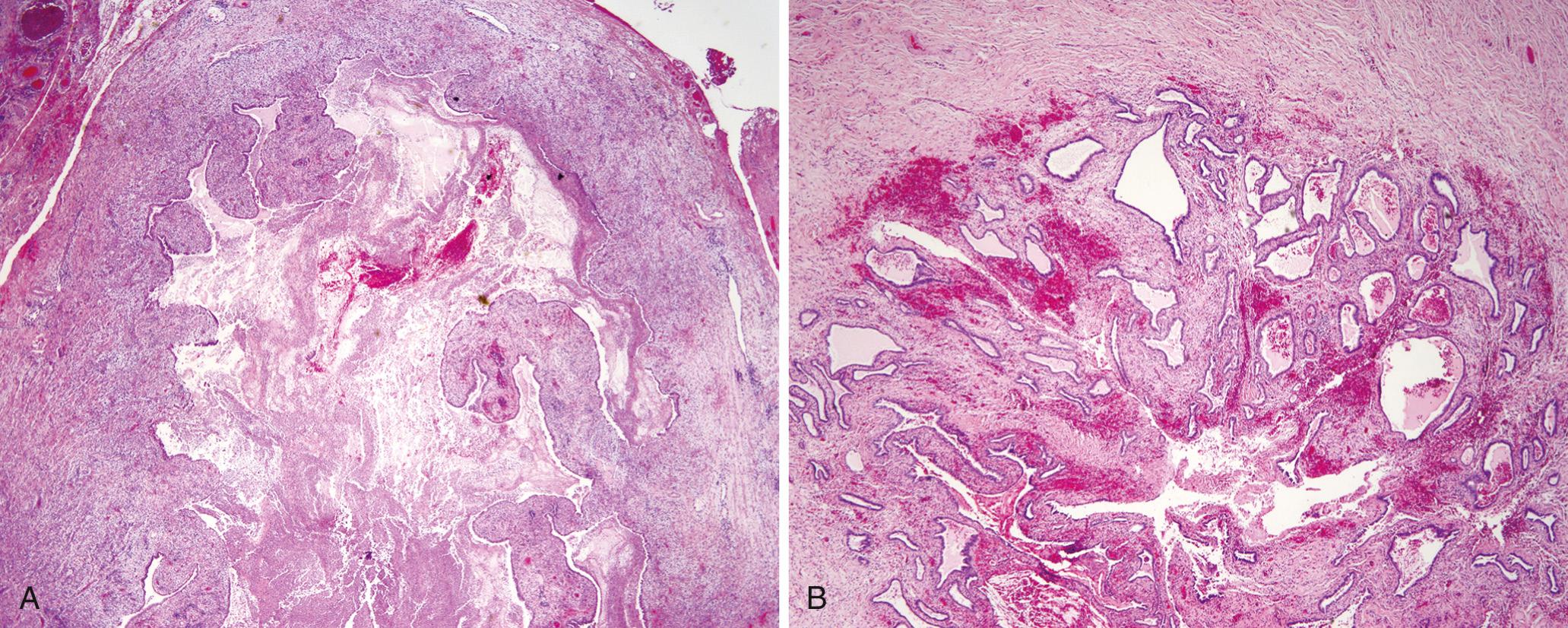 Figure 22.4, Salpingitis. (A) Acute salpingitis; note the dilated tube lumen and edematous tubal plicae expanded by inflammatory cell infiltrates. Pus fills the center of the fallopian tube. (B) Chronic salpingitis showing scarring and fusion of the plicae with formation of glandlike spaces. Such scarring may cause infertility or ectopic tubal pregnancy.