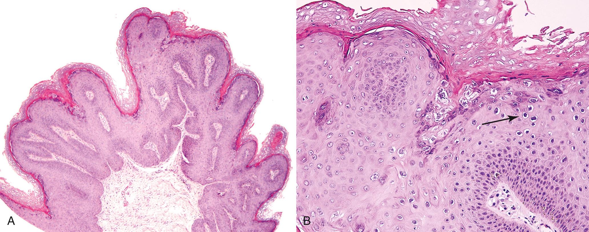 Figure 22.6, Condyloma acuminatum. (A) Low-power view showing exophytic, papillary architecture. (B) High-power view reveals human papillomavirus cytopathic effect (koilocytic atypia) characterized by atypical, enlarged, hyperchromatic nuclei with perinuclear halos (arrow) .