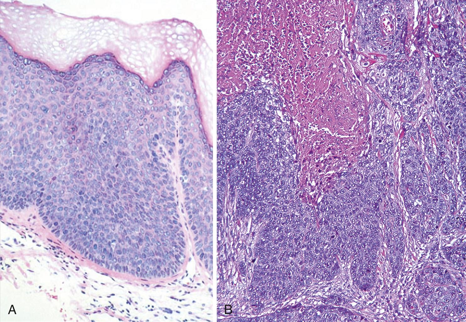 Figure 22.7, Human papillomavirus (HPV)-related vulvar pre-neoplastic and malignant lesions. (A) Classic vulvar intraepithelial neoplasia (HPV positive), showing small, immature basaloid cells encompassing full thickness of the epithelium. No invasion is present. (B) Basaloid vulvar carcinoma (HPV positive), composed of invasive small, immature (basaloid) cells. There is a focus of necrosis (red area).