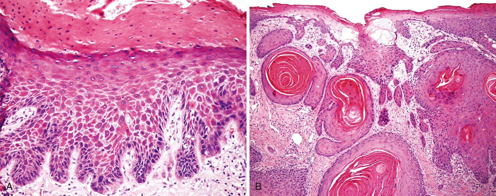 Figure 22.8, Non–human papillomavirus (HPV) vulvar pre-neoplastic and malignant lesions. (A) Differentiated vulvar intraepithelial neoplasia (HPV negative), showing maturation of the superficial layers, hyperkeratosis, and atypia of basal epithelial cells. No invasion is present. (B) Well-differentiated, keratinizing squamous cell carcinoma of the vulva (HPV negative) composed of invasive tumor nests with central keratin pearls.