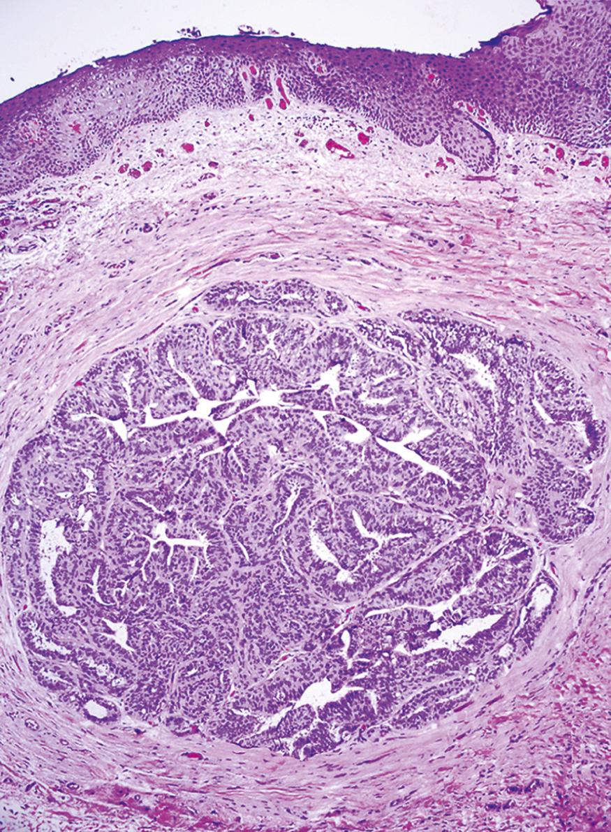 Figure 22.9, Papillary hidradenoma of the vulva, a well-circumscribed tumor composed of benign papillary projections covered with columnar secretory epithelium and underlying myoepithelial cells.