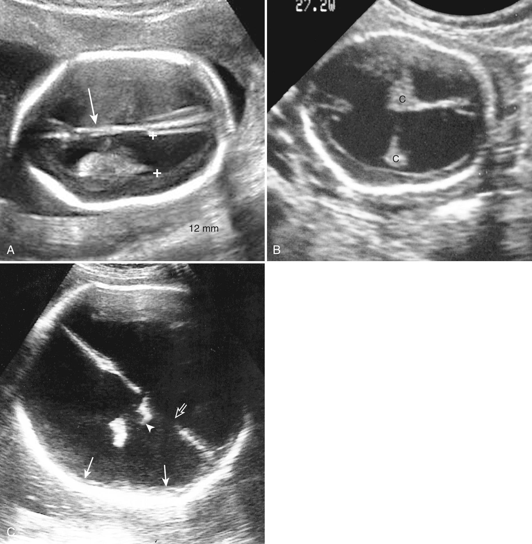 FIG. 34.11, Ventriculomegaly.