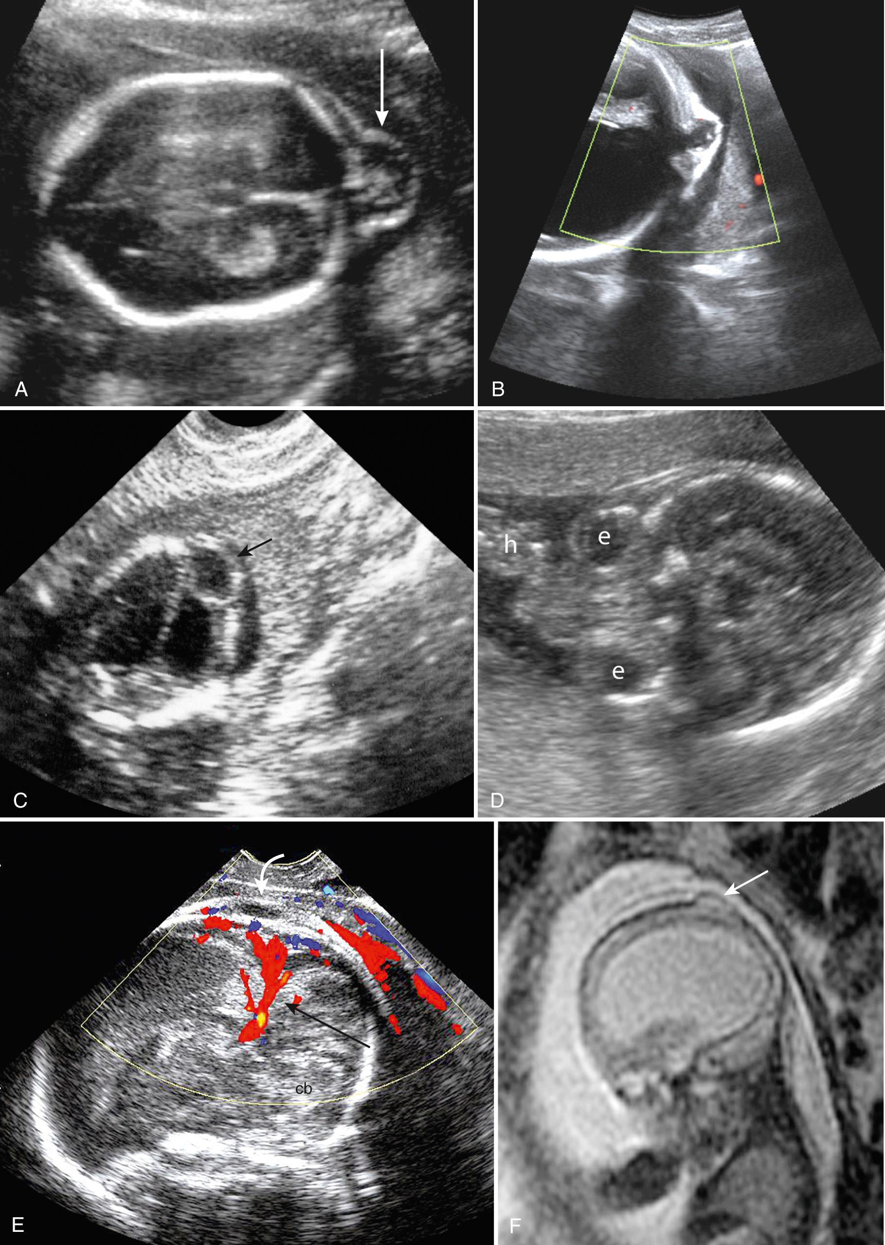 FIG. 34.13, Encephalocele.