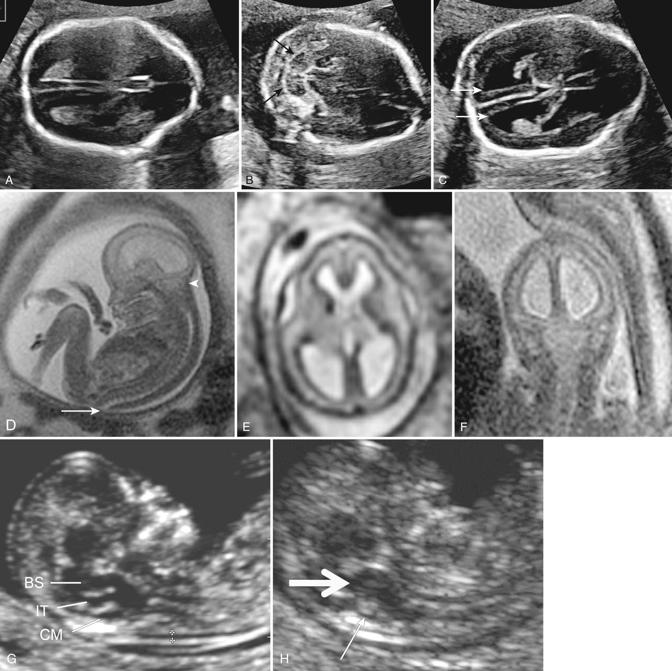 FIG. 34.14, Cranial Findings of Chiari II Malformation With Open Spina Bifida.