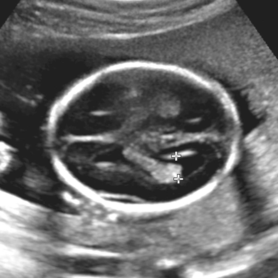 FIG. 34.3, Ventricular Measurement.