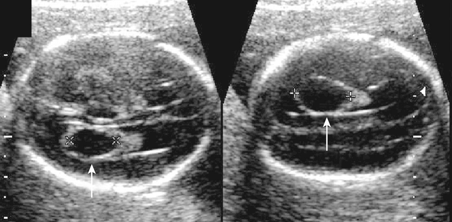 FIG. 34.6, Bilateral Choroid Plexus Cysts (Arrows).