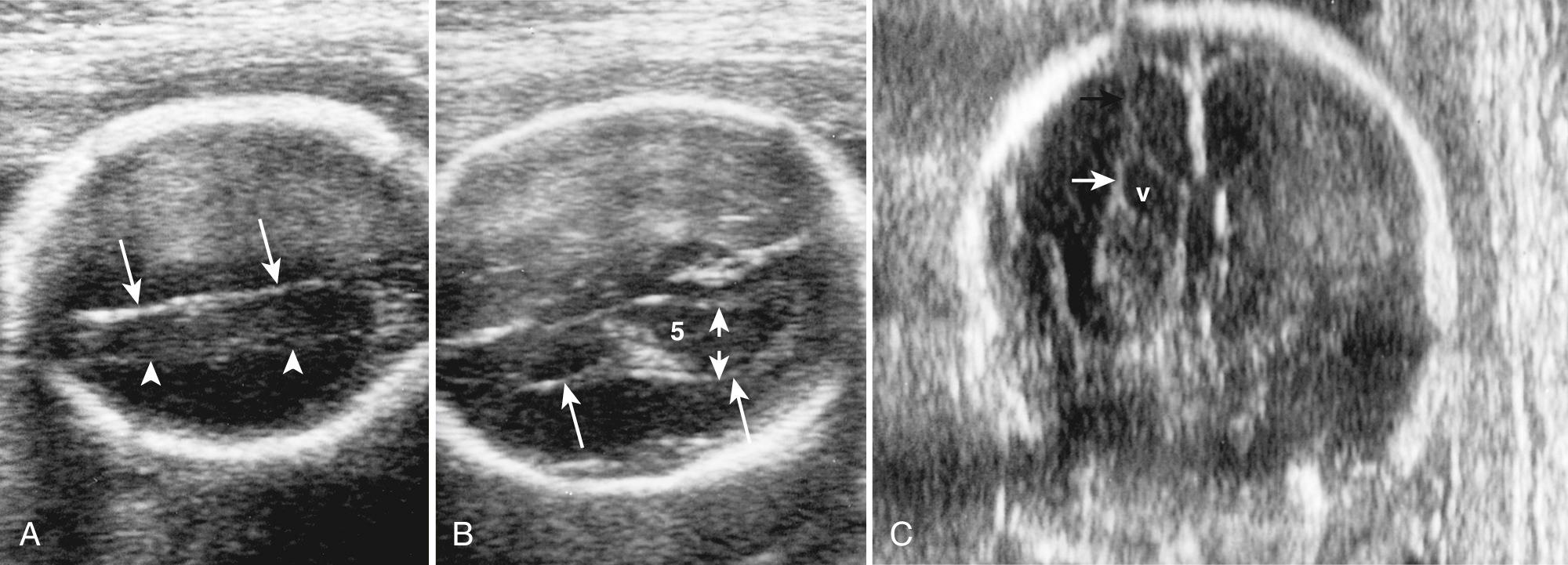 FIG. 34.10, Supraventricular Marginal Venous Echoes at 26 Menstrual Weeks Versus Ventricular Walls.