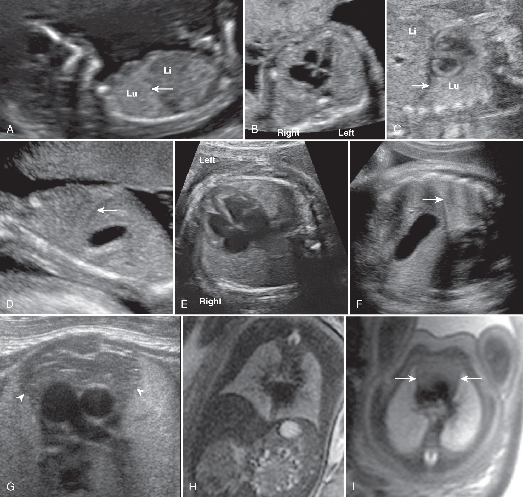 FIG. 36.1, Normal Fetal Chest.