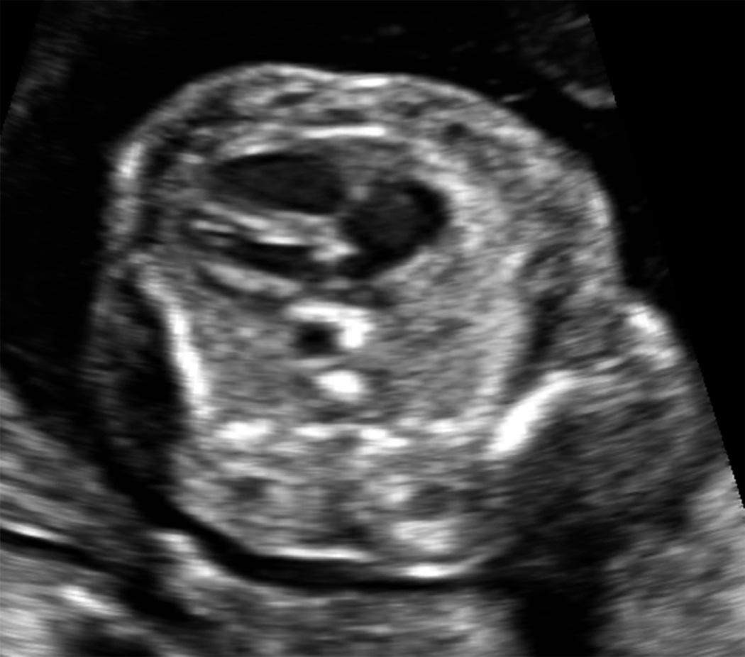 FIG. 36.2, Secondary Pulmonary Hypoplasia in Fetus With Thanatophoric Dysplasia.