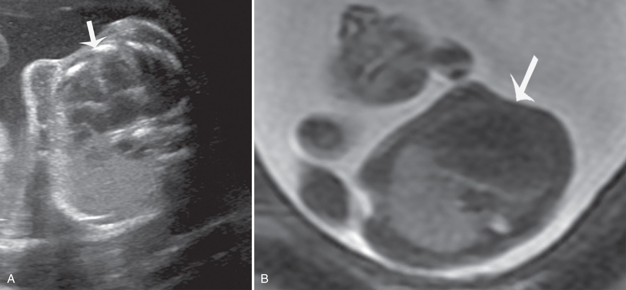 FIG. 36.3, Unilateral Pulmonary Hypoplasia.