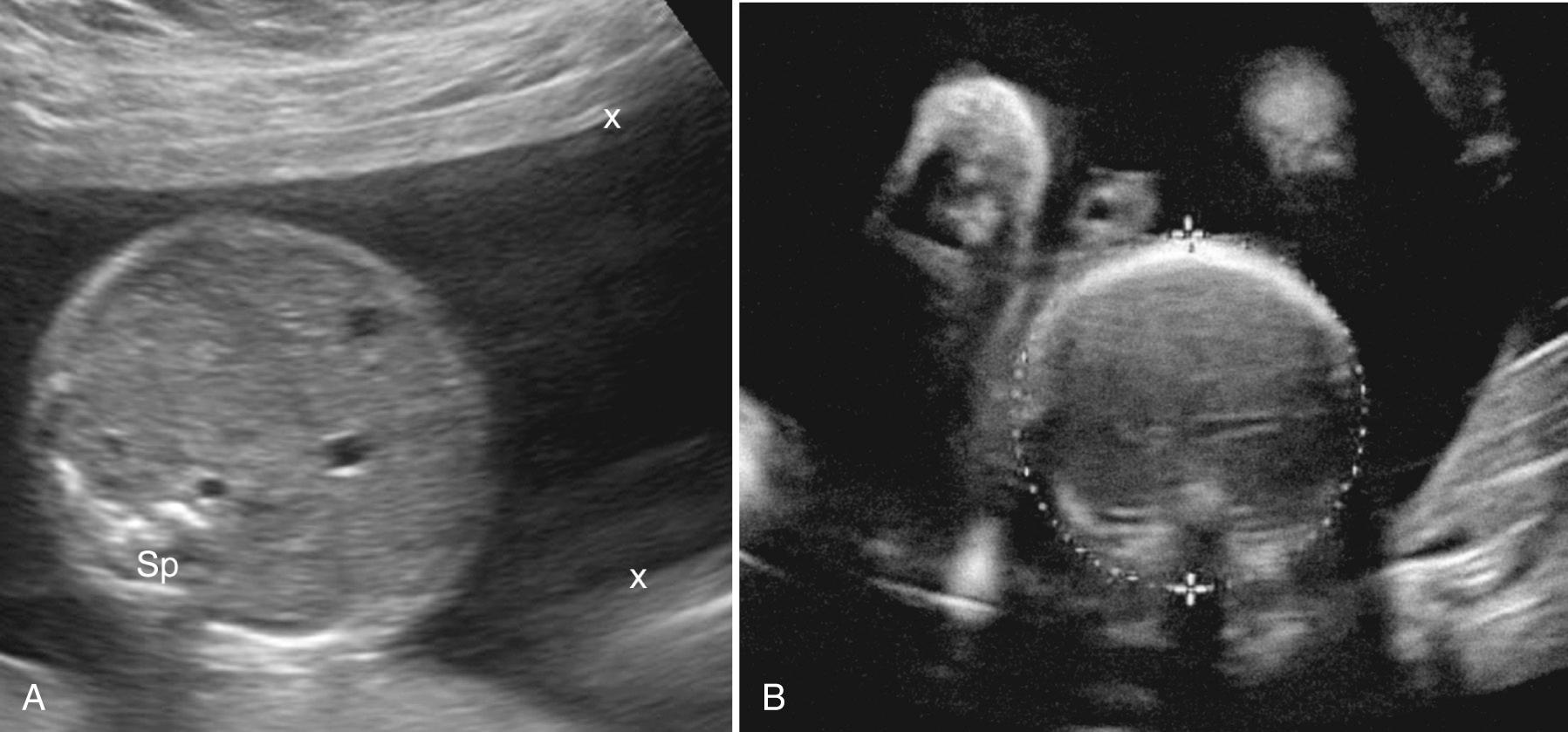 FIG. 38.1, Esophageal Atresia and Absent Stomach.