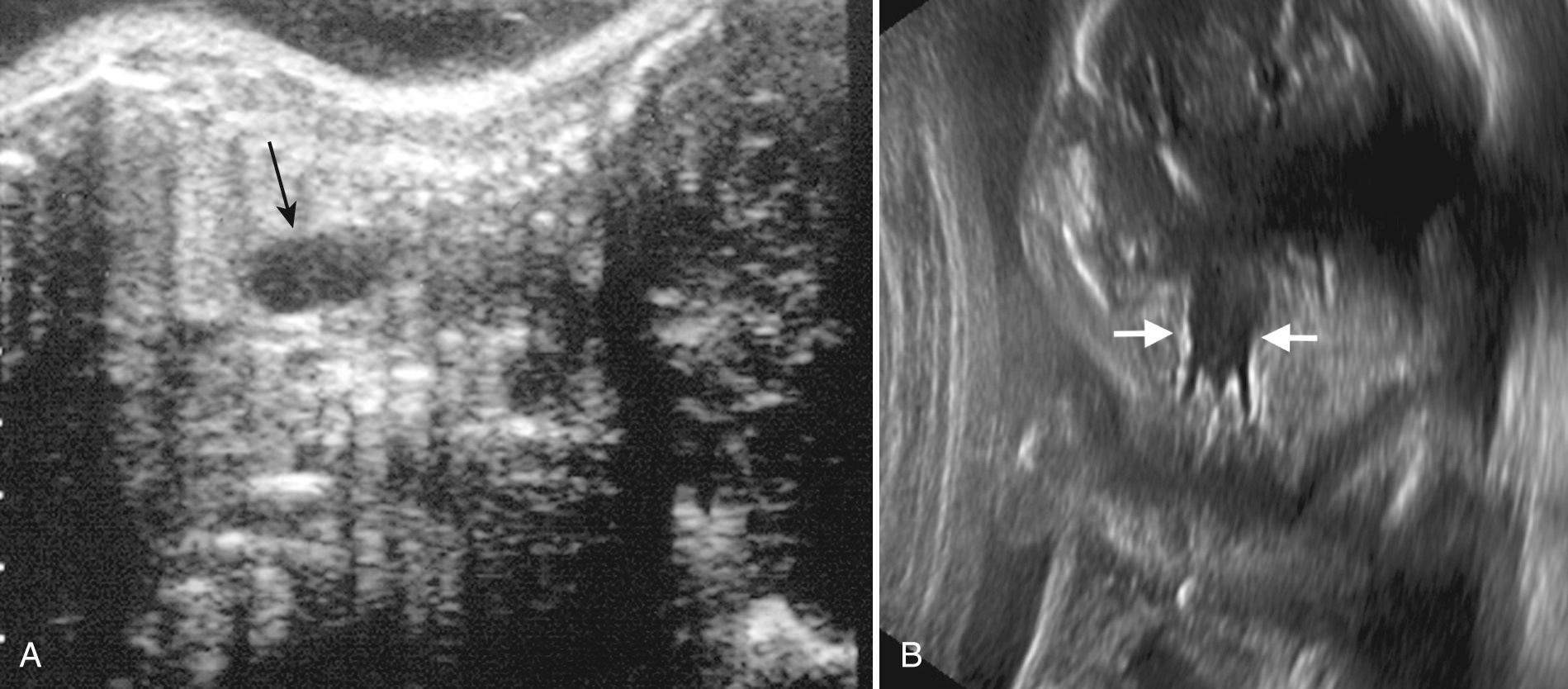 FIG. 38.2, Esophageal Atresia.