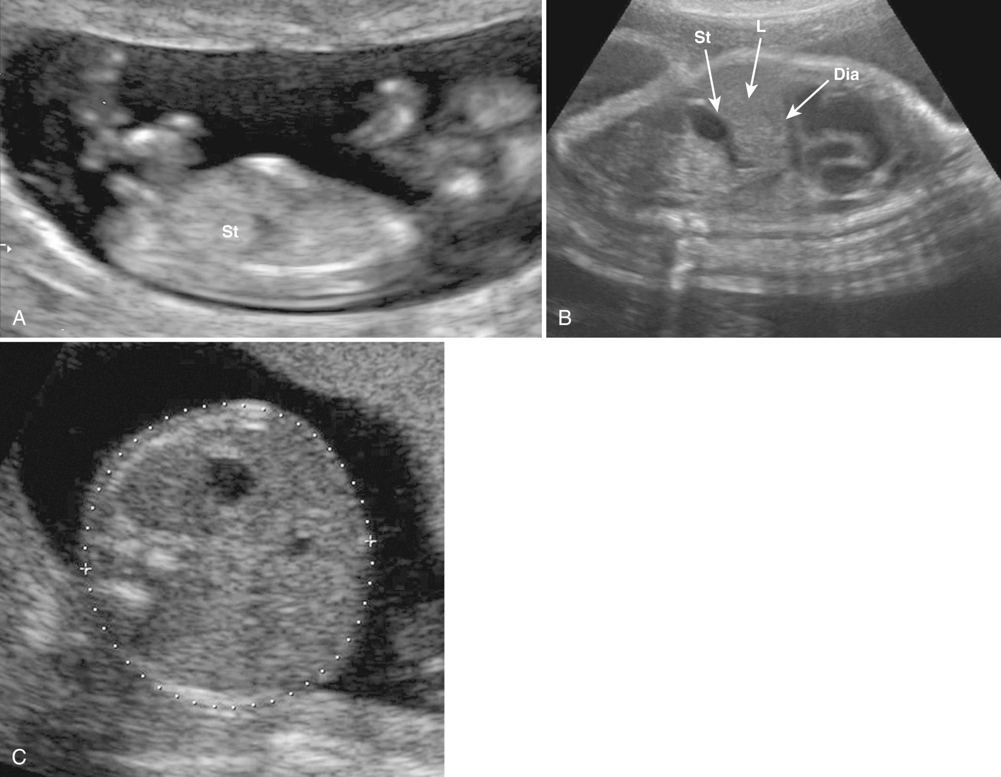 FIG. 38.3, Normal Stomach.