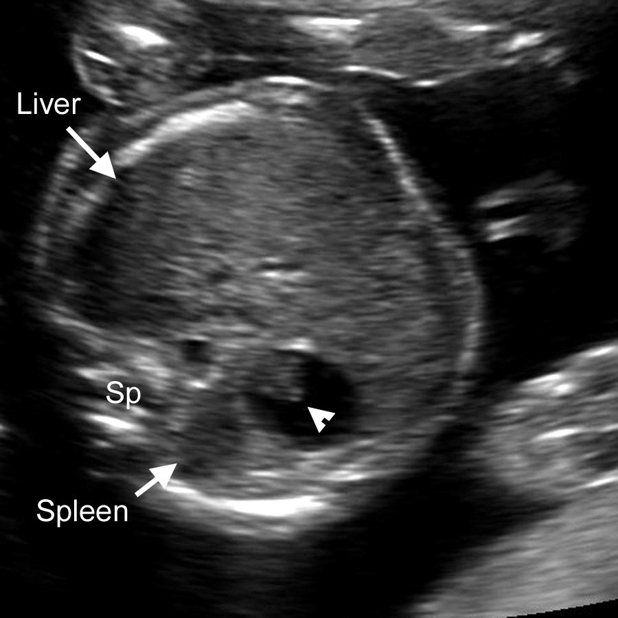 FIG. 38.7, Gastric Debris.