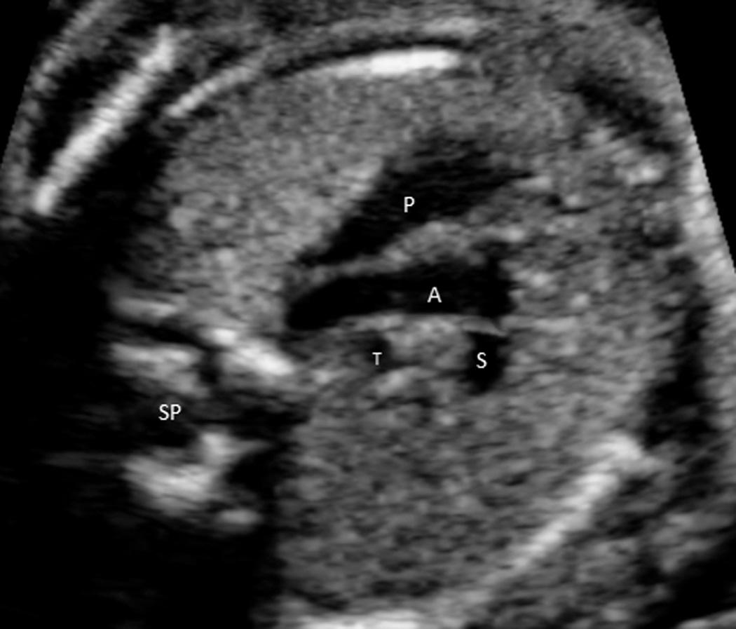 FIG. 37.11, Three-vessel and trachea view shows the correct orientation of the main pulmonary artery–ductus arteriosus confluence (P), the transverse aortic arch (A), and the superior vena cava (S). This view also shows the two great vessels correctly positioned on the left side of the trachea (T). See also Video 37.6 . SP, Spine.