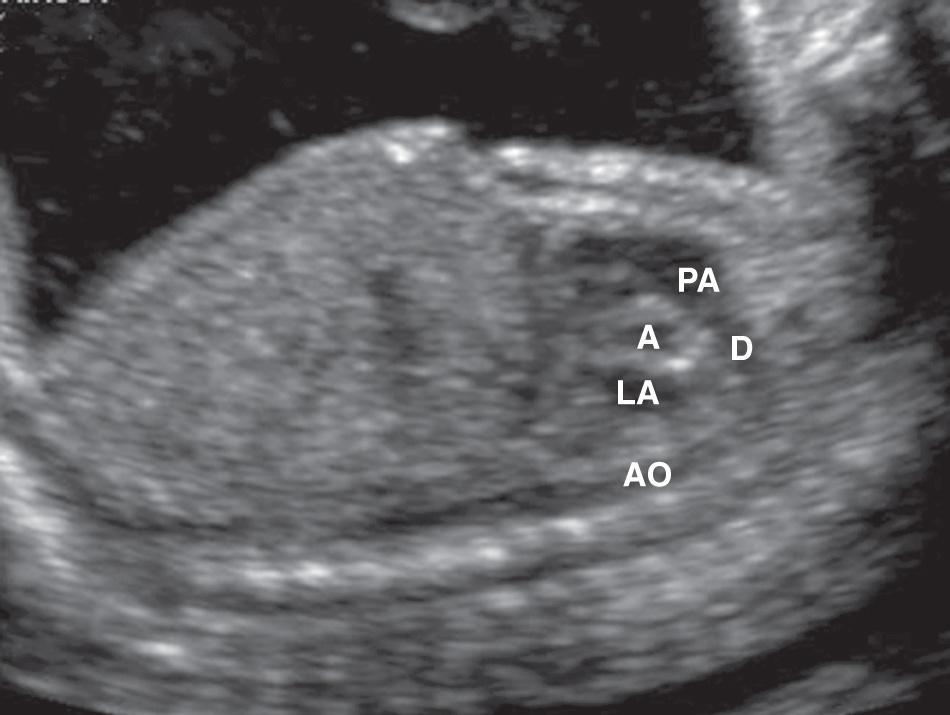 FIG. 37.13, Normal Ductal Arch.