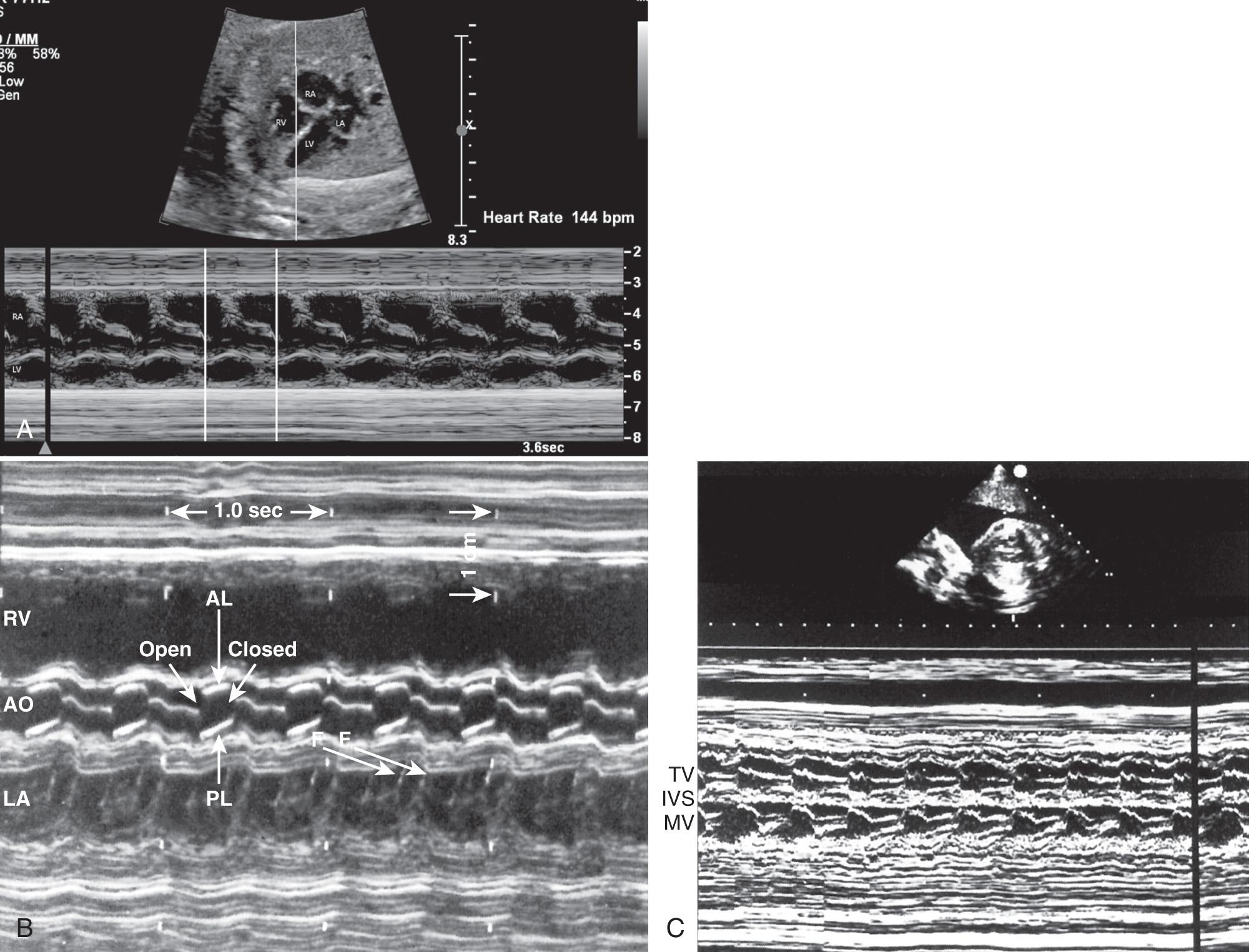 FIG. 37.14, M-Mode Echocardiography.