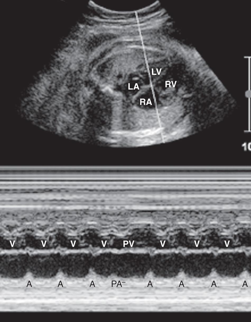 FIG. 37.15, Using M-Mode Echocardiography to Analyze an Arrhythmia: Conducted Premature Atrial Contractions.