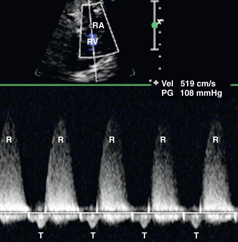 FIG. 37.17, Tricuspid Insufficiency.