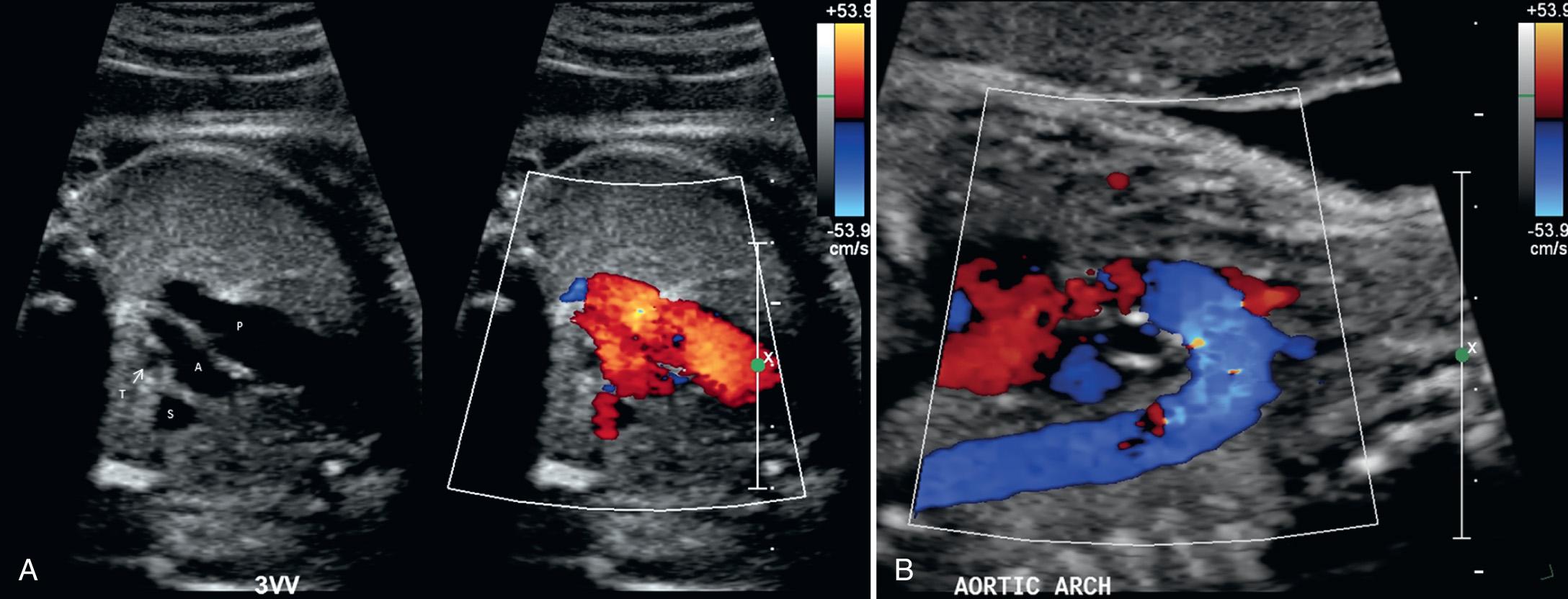 FIG. 37.18, Using Color Doppler Ultrasound to Access Normal Blood Flow.