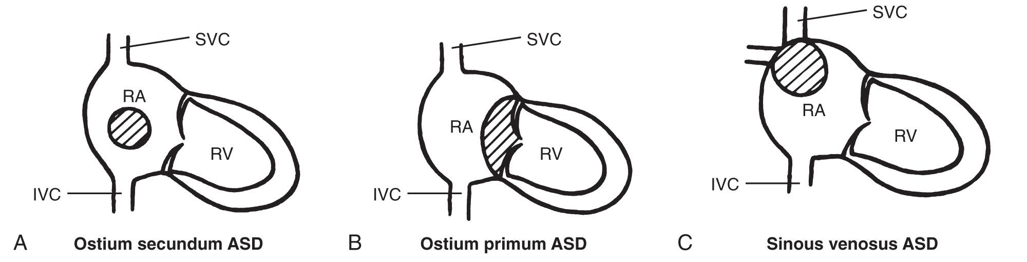 FIG. 37.20, Types of Atrial Septal Defect (ASD).