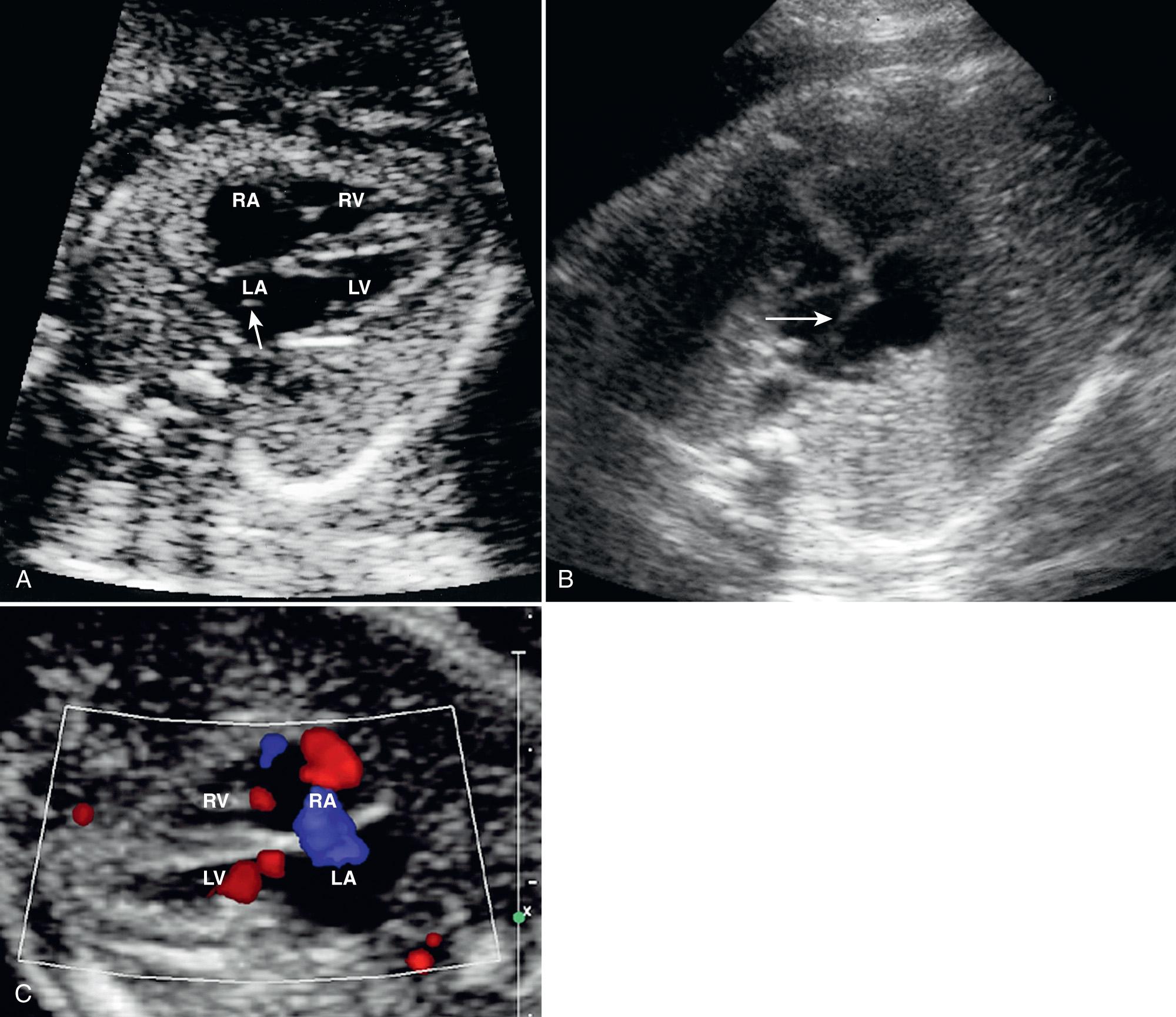 FIG. 37.21, Foraminal Flap and Foramen Ovale.