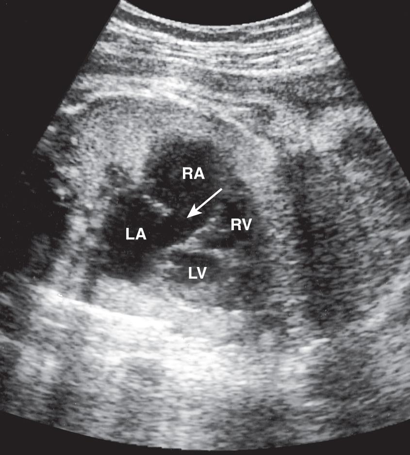 FIG. 37.22, Four-chamber view shows an ostium primum atrial septal defect (arrow) in a fetus with an atrioventricular septal defect. LA, Left atrium; LV, left ventricle; RA, right atrium; RV, right ventricle.