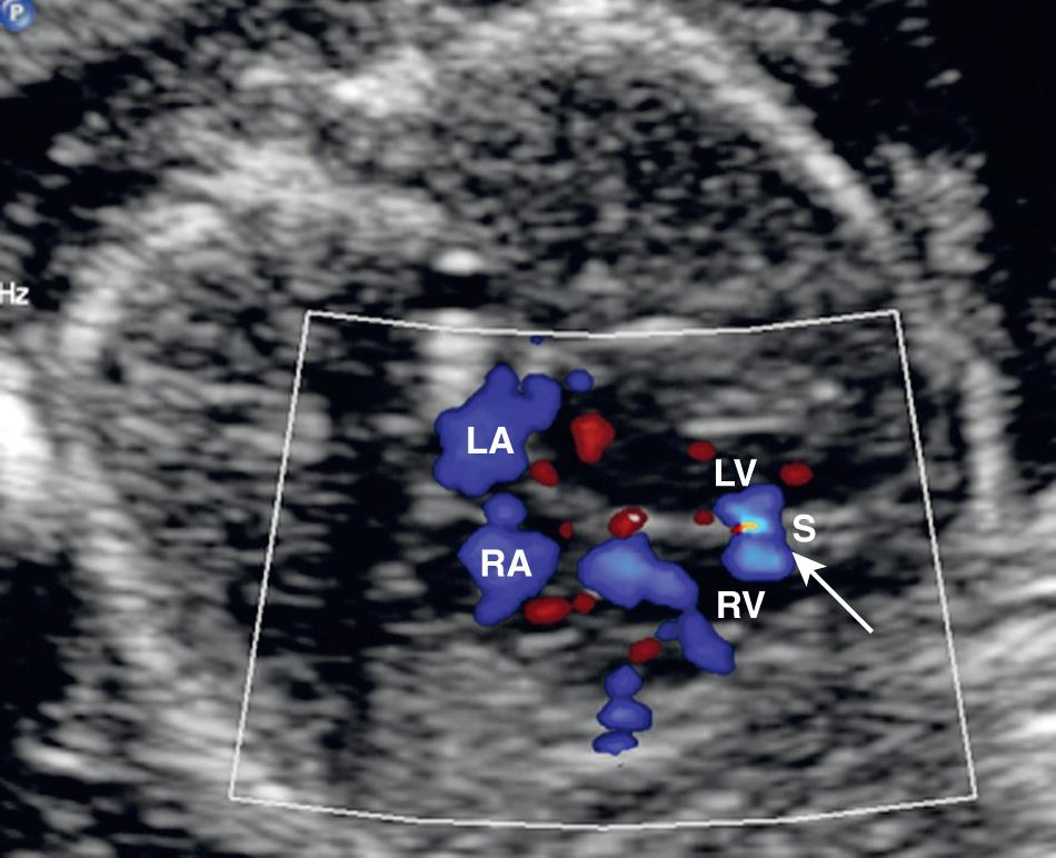 FIG. 37.24, Muscular Ventricular Septal Defect (VSD).