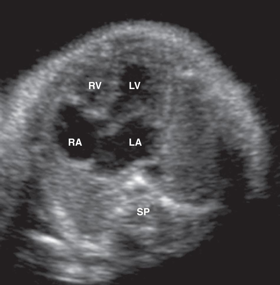 FIG. 37.29, Hypoplastic Right Ventricle.