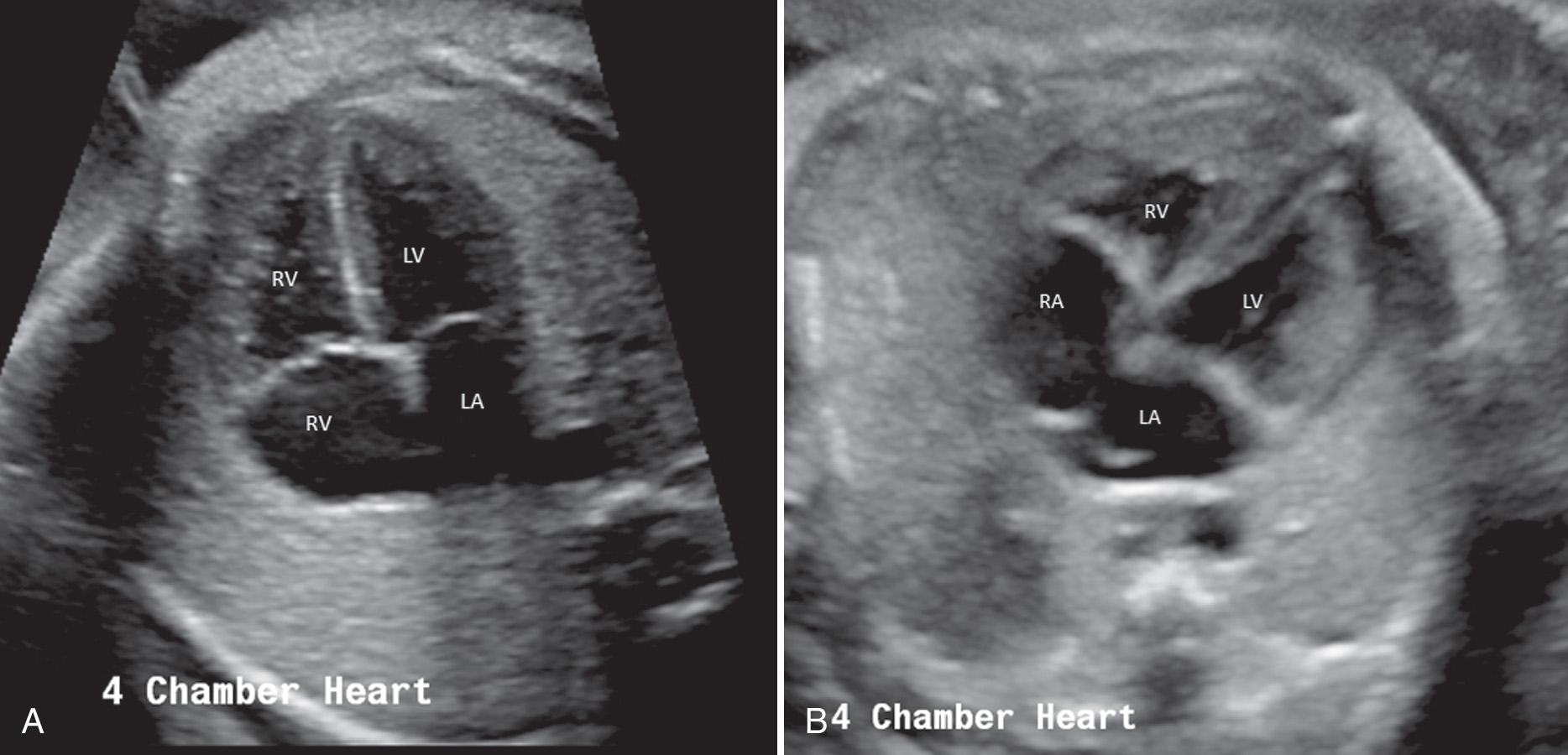 FIG. 37.5, Four-Chamber View of Heart.