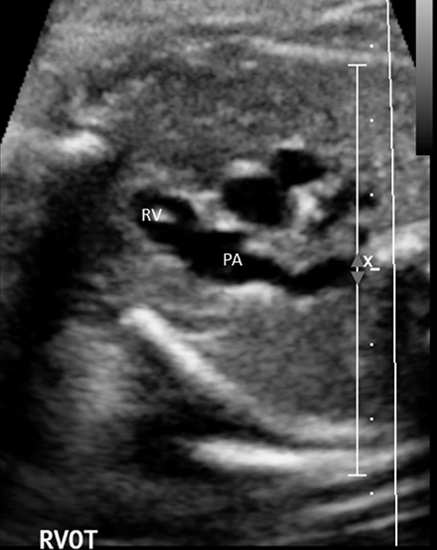 FIG. 37.7, Continuity of pulmonary artery (PA) with right ventricle (RV). See also Video 37.3 and Video 37.4 .