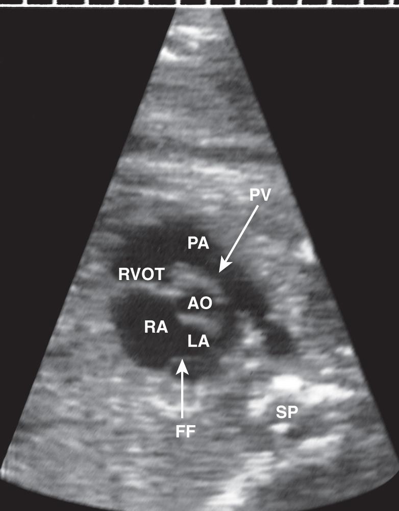 FIG. 37.9, Short-Axis View of Great Vessels.