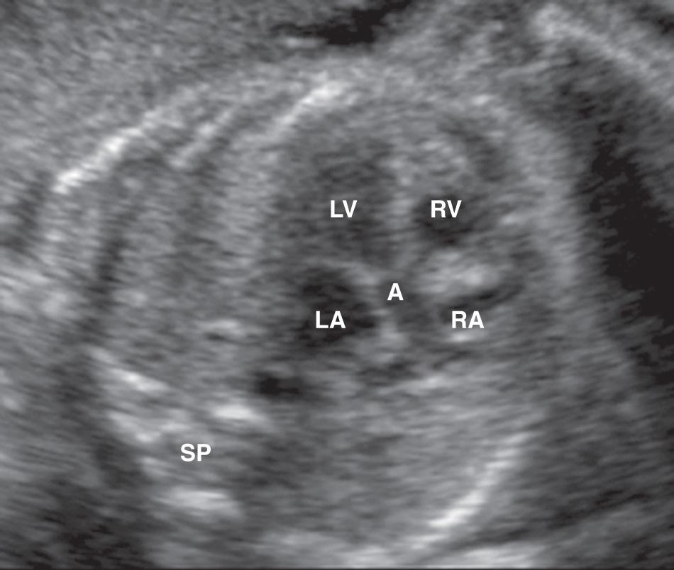 FIG. 37.10, Apical five-chamber view shows continuity of the aorta (A) with the left ventricle (LV). LA, Left atrium; RA, right atrium; RV, right ventricle; SP, spine.