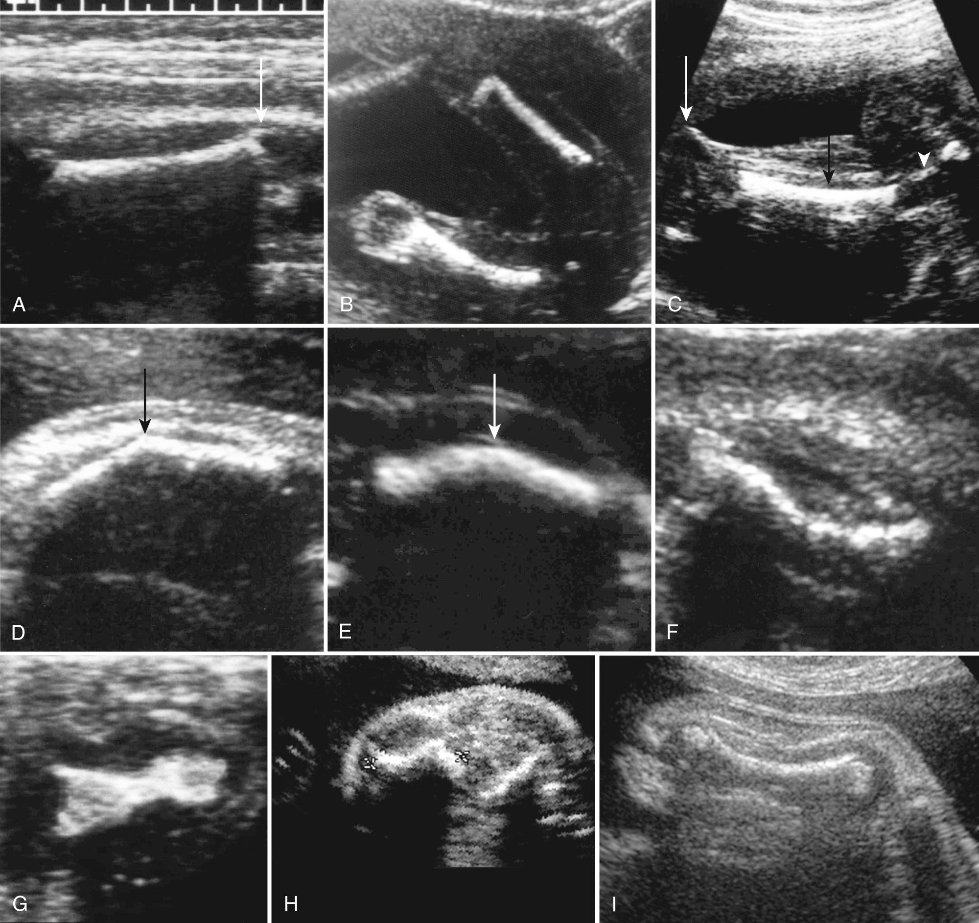 FIG. 40.2, Normal Femur and Spectrum of Abnormal Appearances.