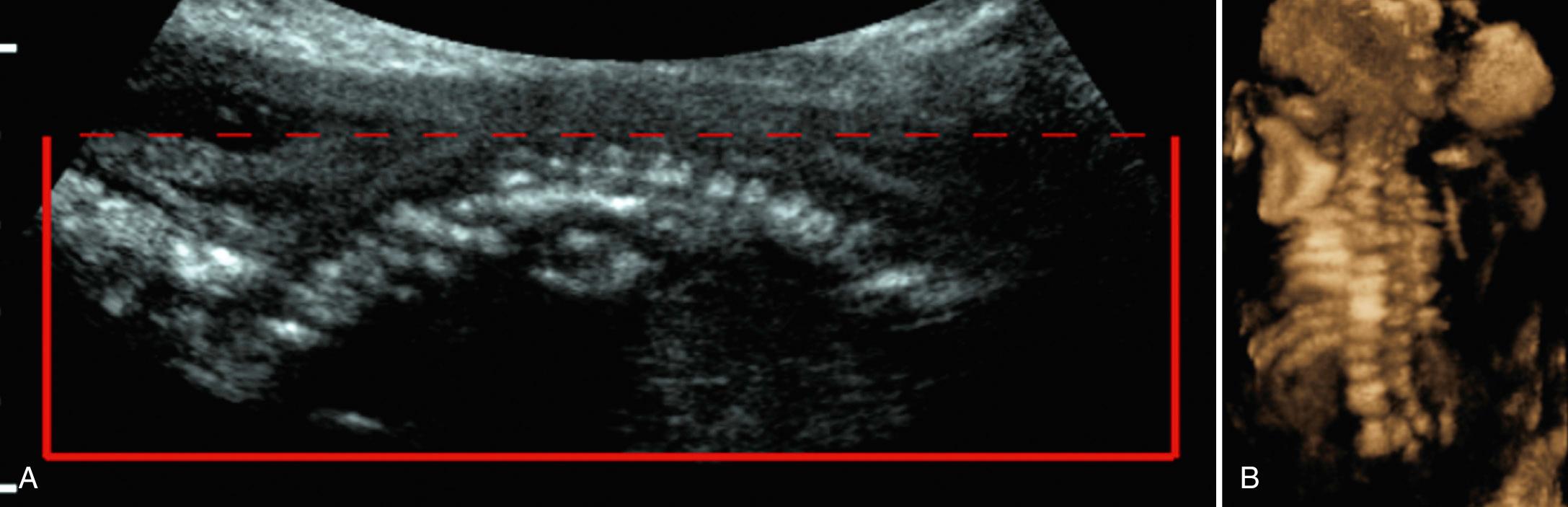 FIG. 40.6, Spondylocostal Dysostosis at 22 Weeks.