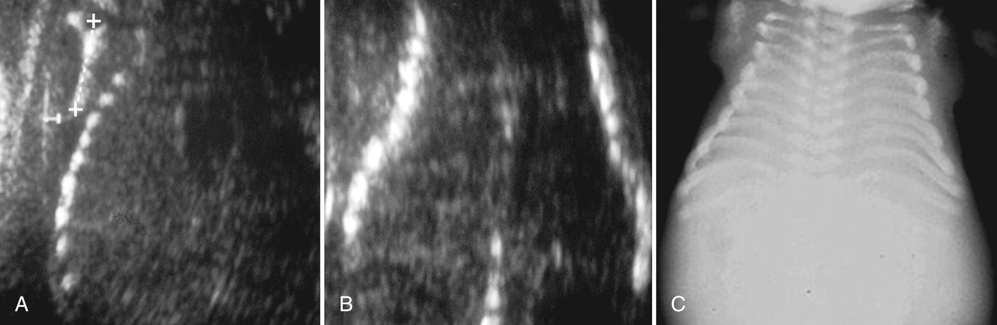 FIG. 40.7, Campomelic Dysplasia and Pulmonary Hypoplasia.