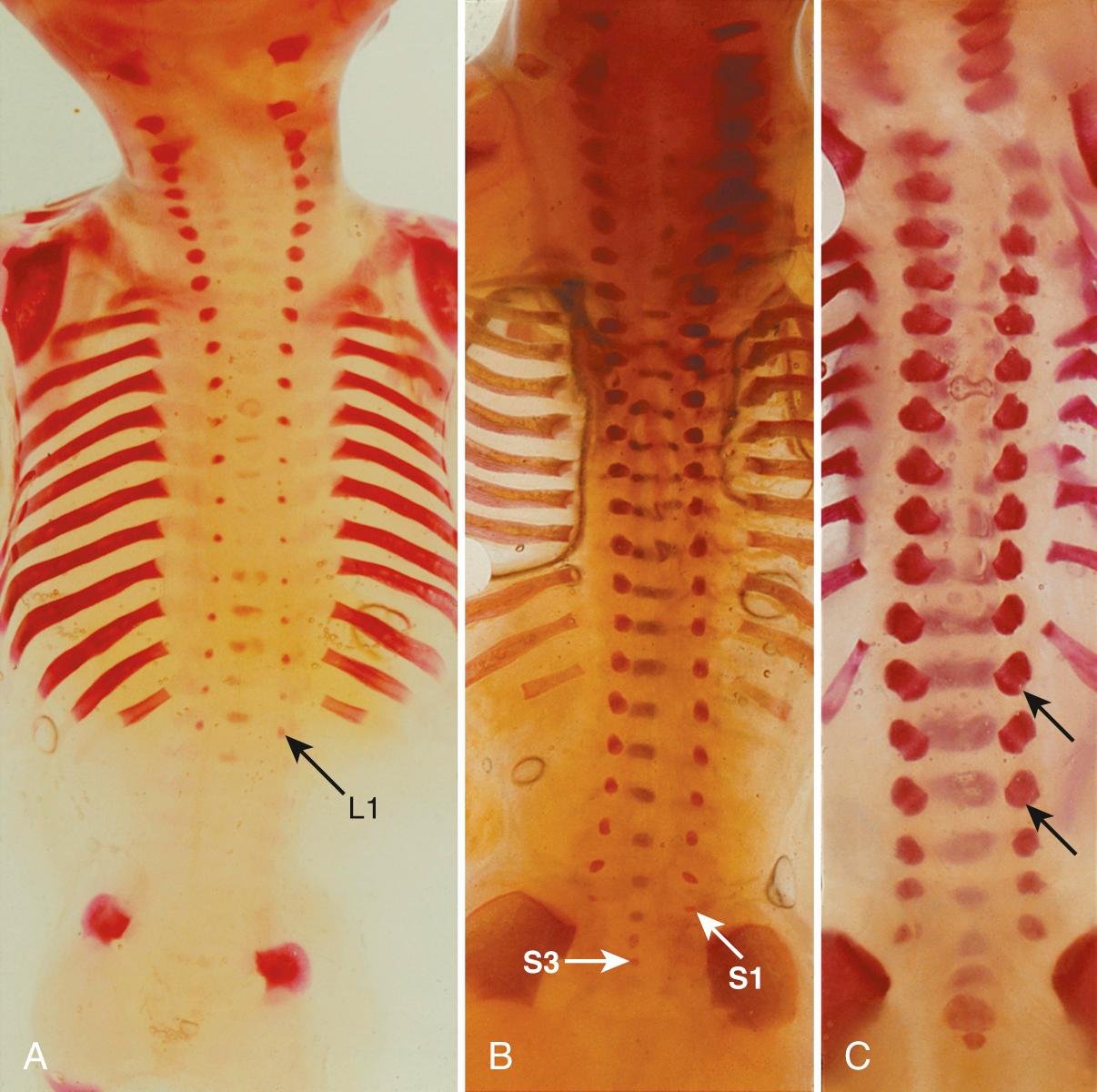 FIG. 35.2, Spine Ossification at 11 Weeks + 4 Days' Menstrual Age.