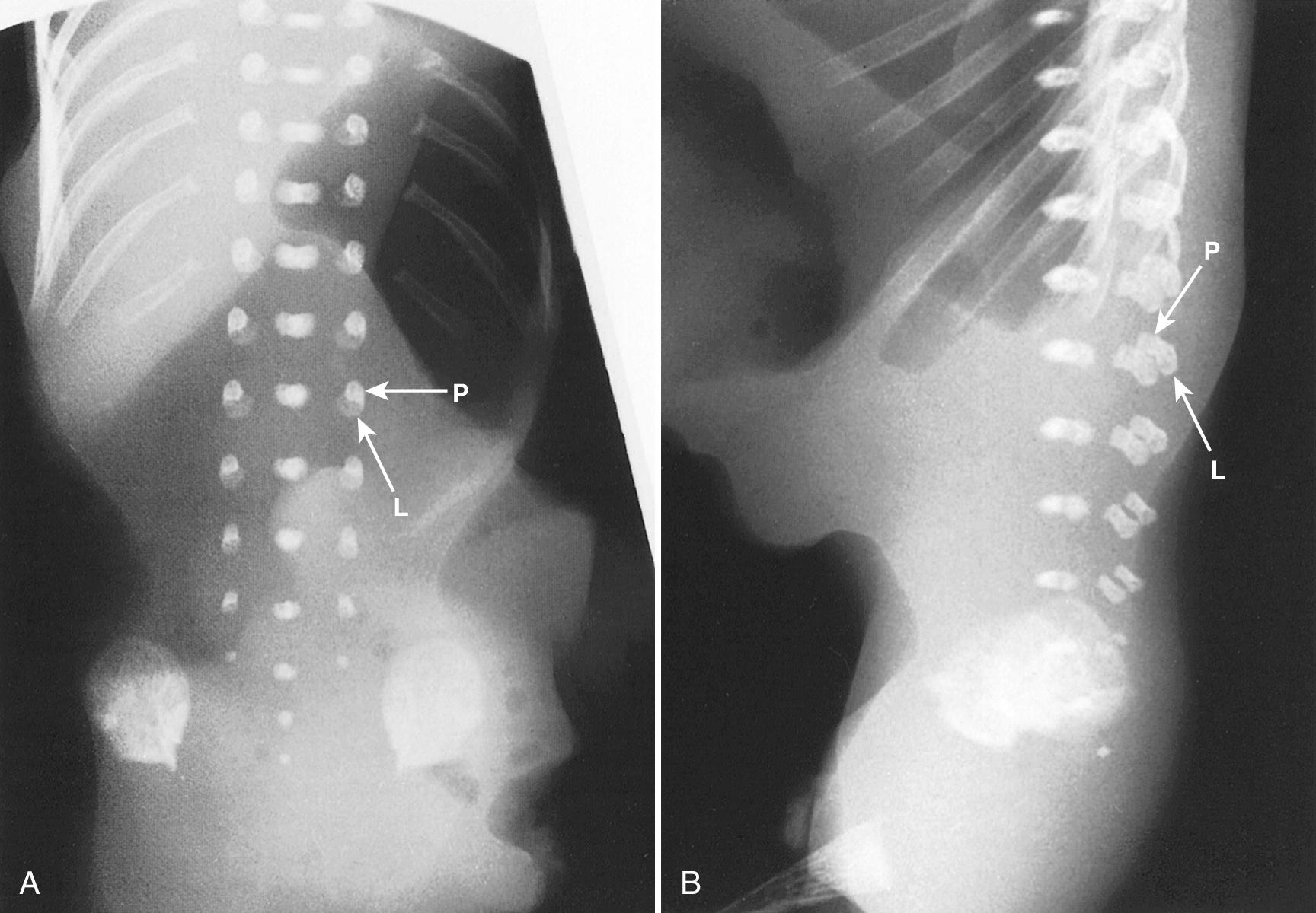 FIG. 35.3, Spine Ossification on Radiographs at 14 Weeks' Gestation.